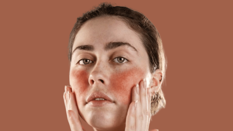 Lupus: A Complex Autoimmune Disease That Requires Deep Awareness and Understanding